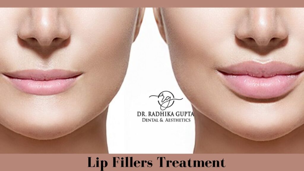 Lip Fillers Treatment - Dr. Radhika Gupta